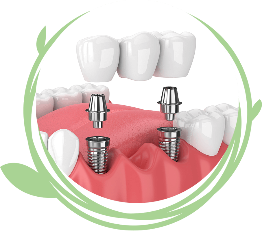 Clovis Family Dentistry|Dental Implant Procedure