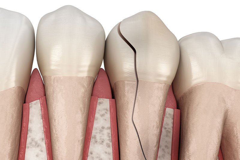 Clovis Family Dentistry|CEREC Same Day Crowns & Bridges