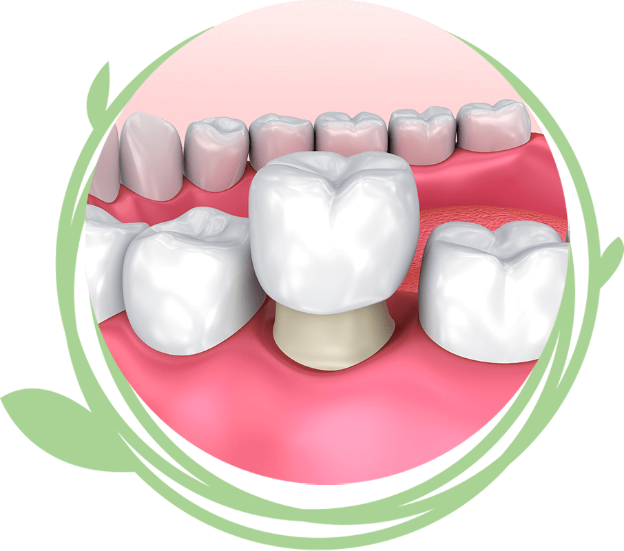 Clovis Family Dentistry|CEREC Same Day Crowns & Bridges