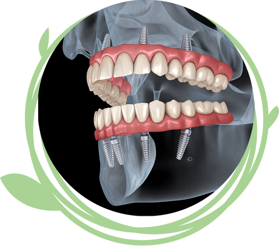 Clovis Family Dentistry|Dental Implant Procedure