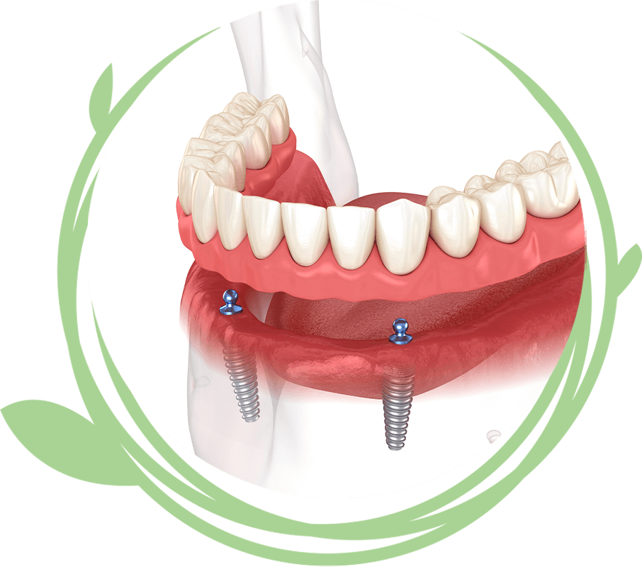 Clovis Family Dentistry|Dental Implant Procedure