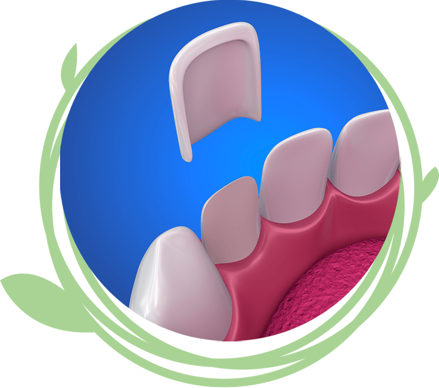 Clovis Family Dentistry|Veneers & Lumineers