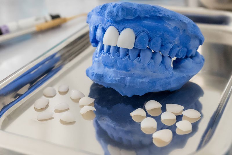Clovis Family Dentistry|Veneers & Lumineers