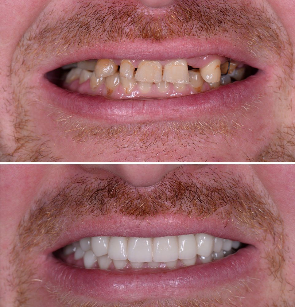 Clovis Family Dentistry|Before & After Photos