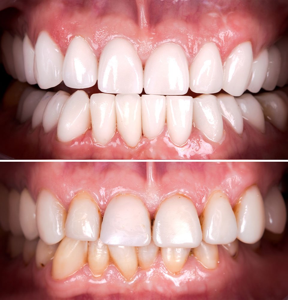 Clovis Family Dentistry|Before & After Photos