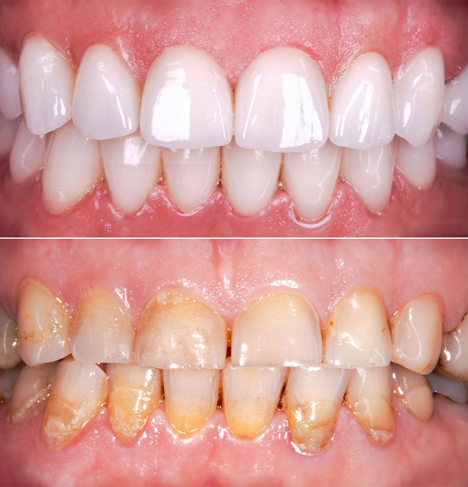 Clovis Family Dentistry|Before & After Photos