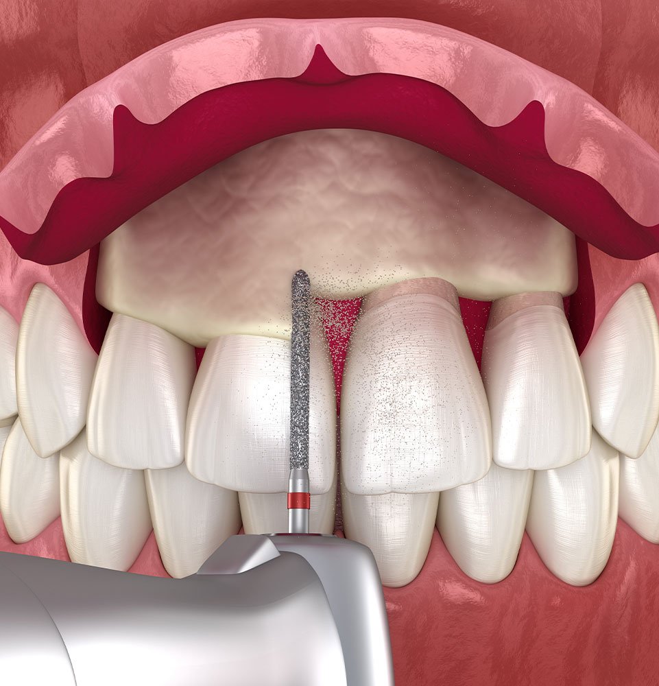 Clovis Family Dentistry|Periodontics