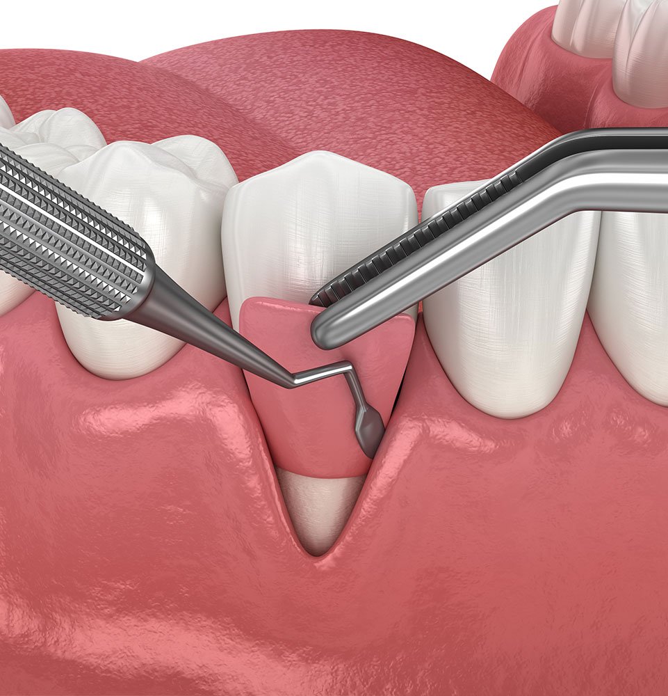 Clovis Family Dentistry|Periodontics