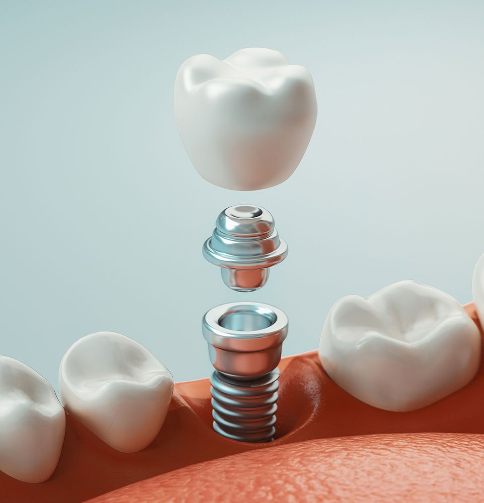 Clovis Family Dentistry|Oral Surgery