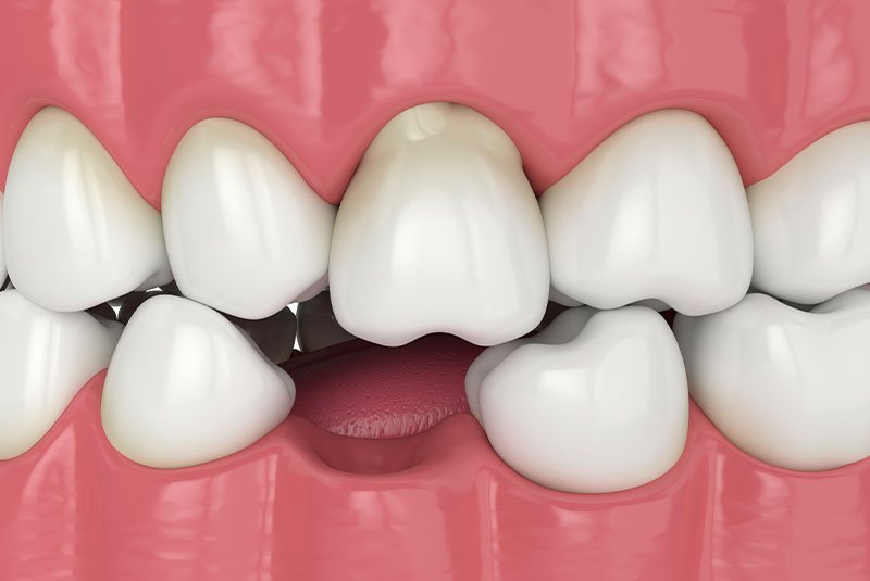 Clovis Family Dentistry|Full Mouth Rehabilitation