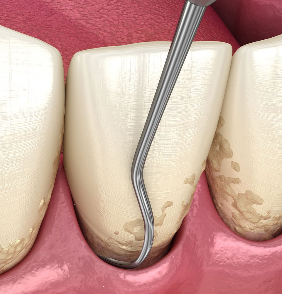 Clovis Family Dentistry|Periodontics