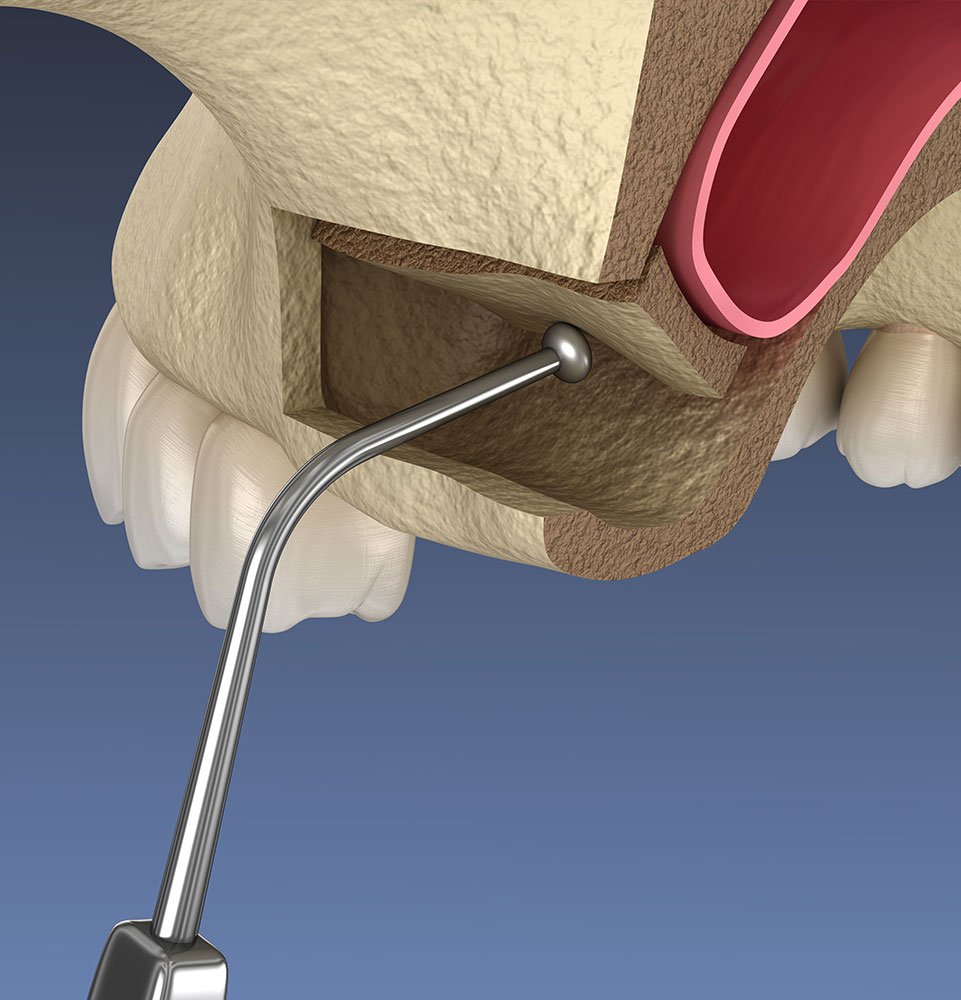 Clovis Family Dentistry|Oral Surgery
