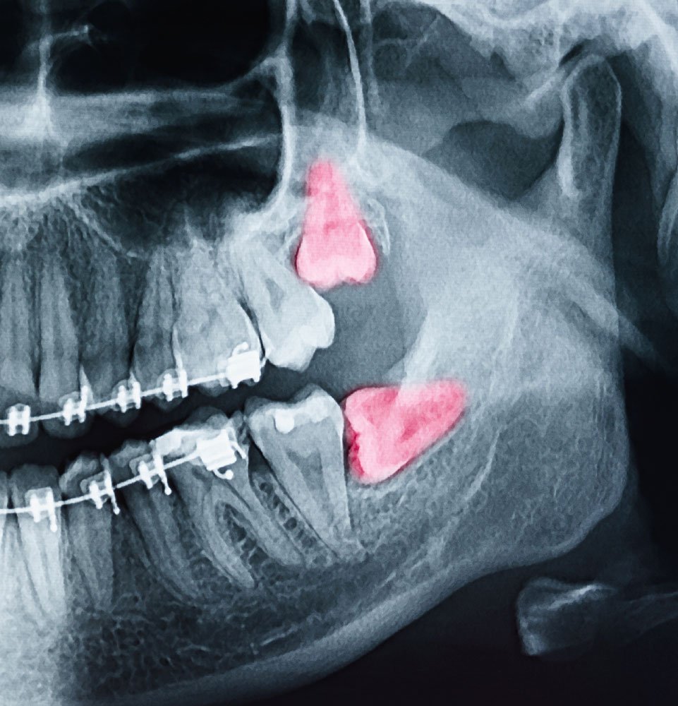 Clovis Family Dentistry|Oral Surgery