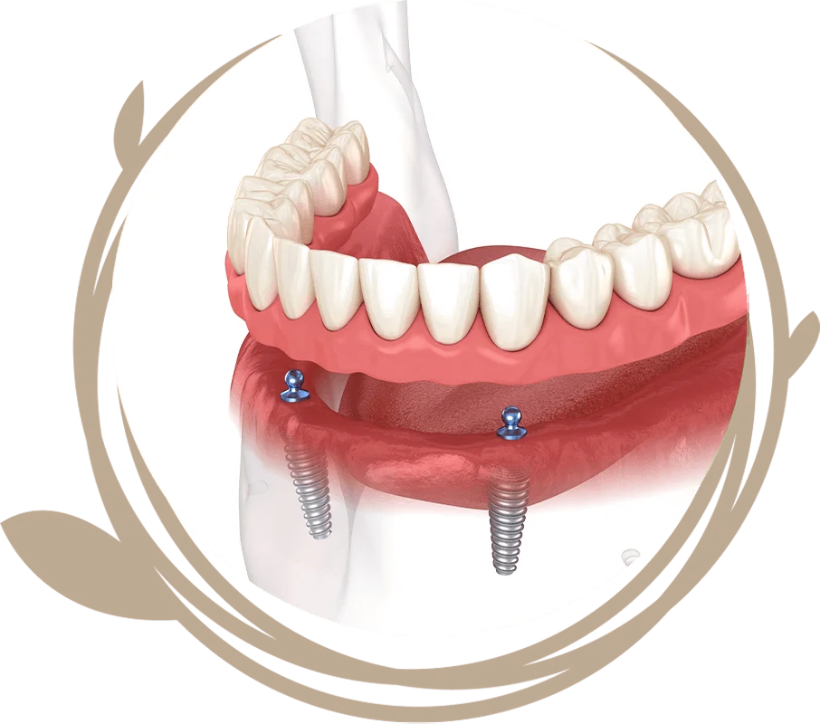 Clovis Family Dentistry|Dental Implant Procedure