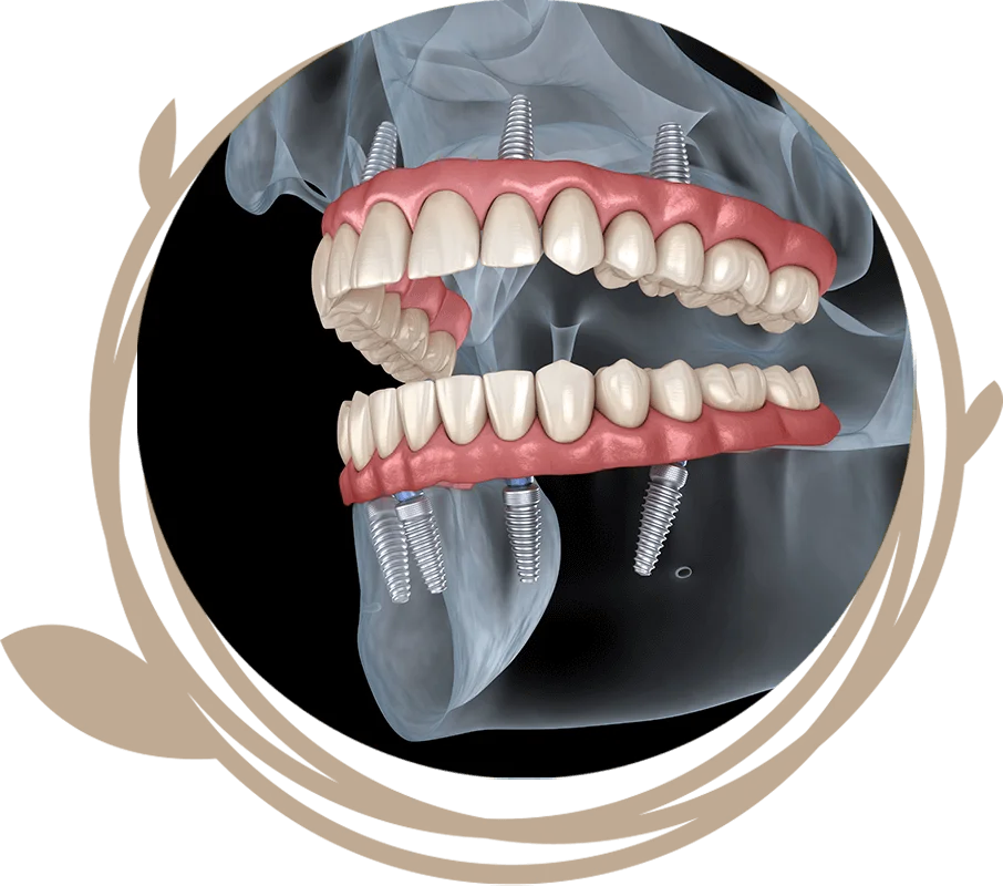 Clovis Family Dentistry|Dental Implant Procedure