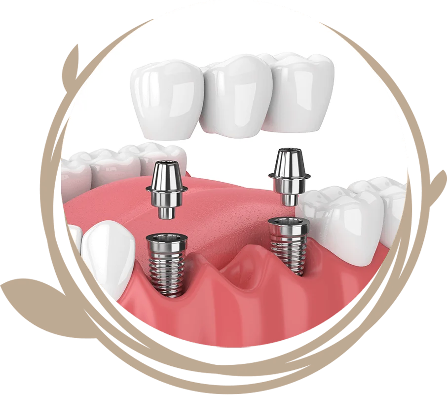 Clovis Family Dentistry|Dental Implant Procedure