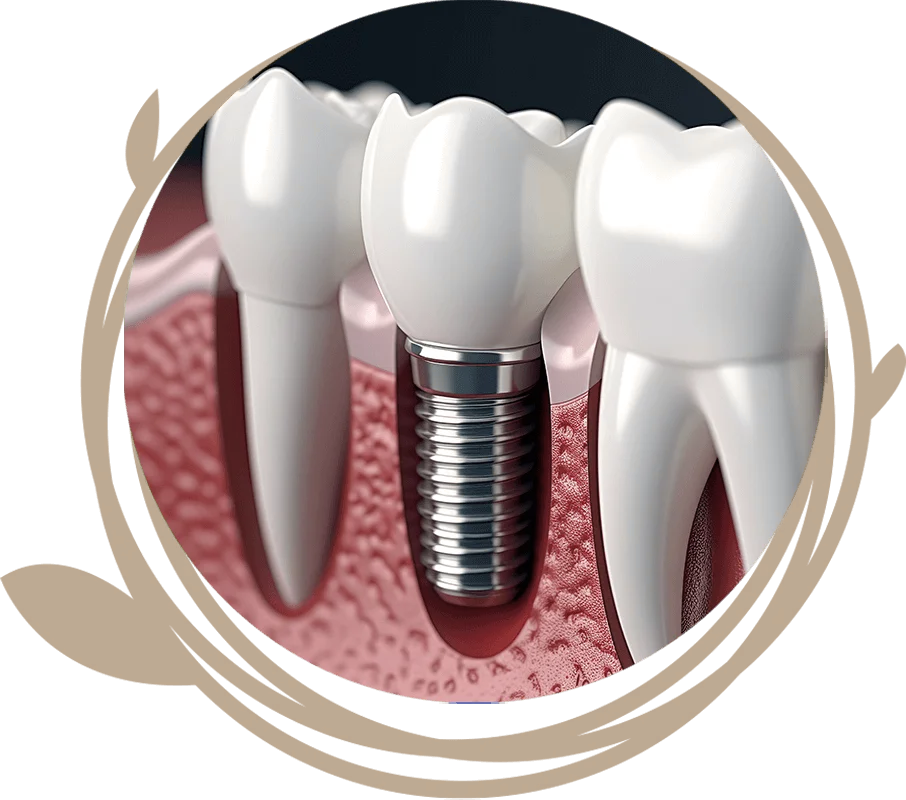 Clovis Family Dentistry|Dental Implant Procedure