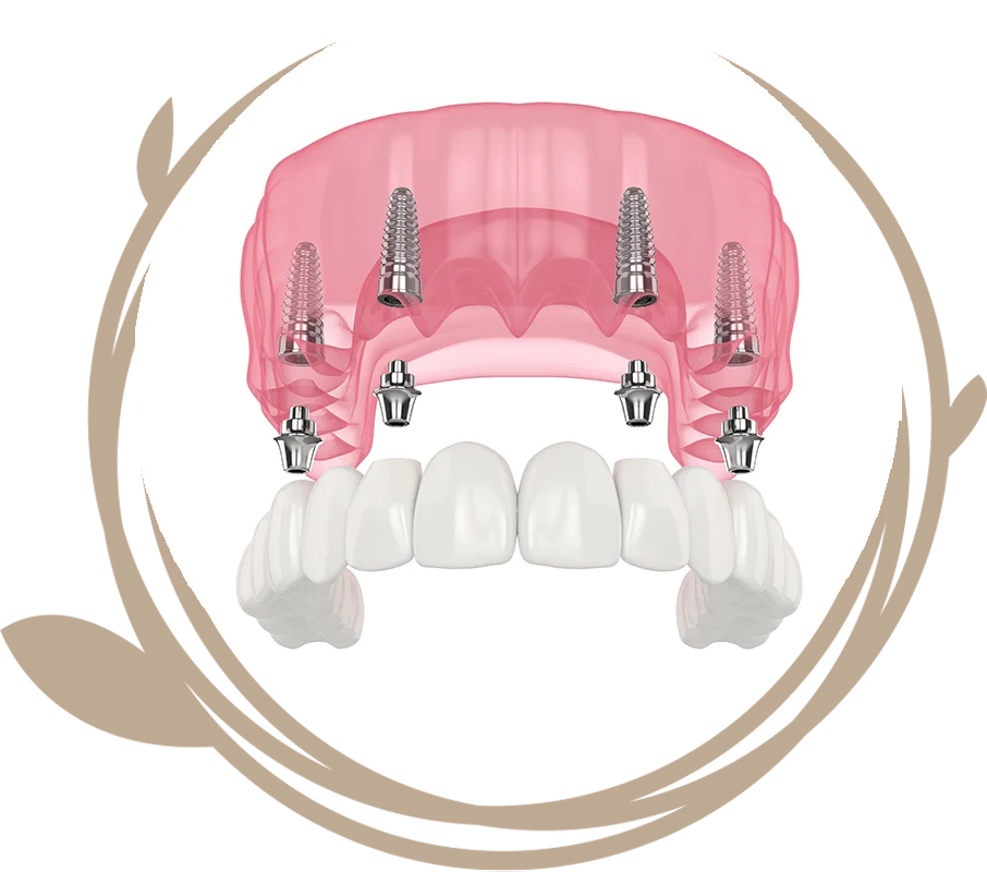 Clovis Family Dentistry|Fixed Teeth vs. Removable