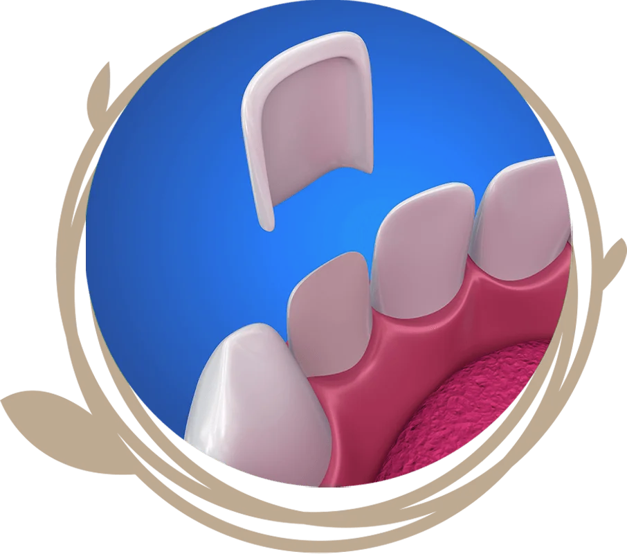 Clovis Family Dentistry|Veneers & Lumineers