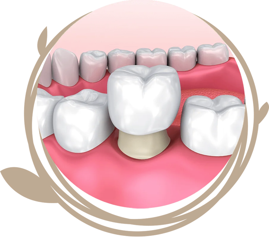 Clovis Family Dentistry|CEREC Same Day Crowns & Bridges